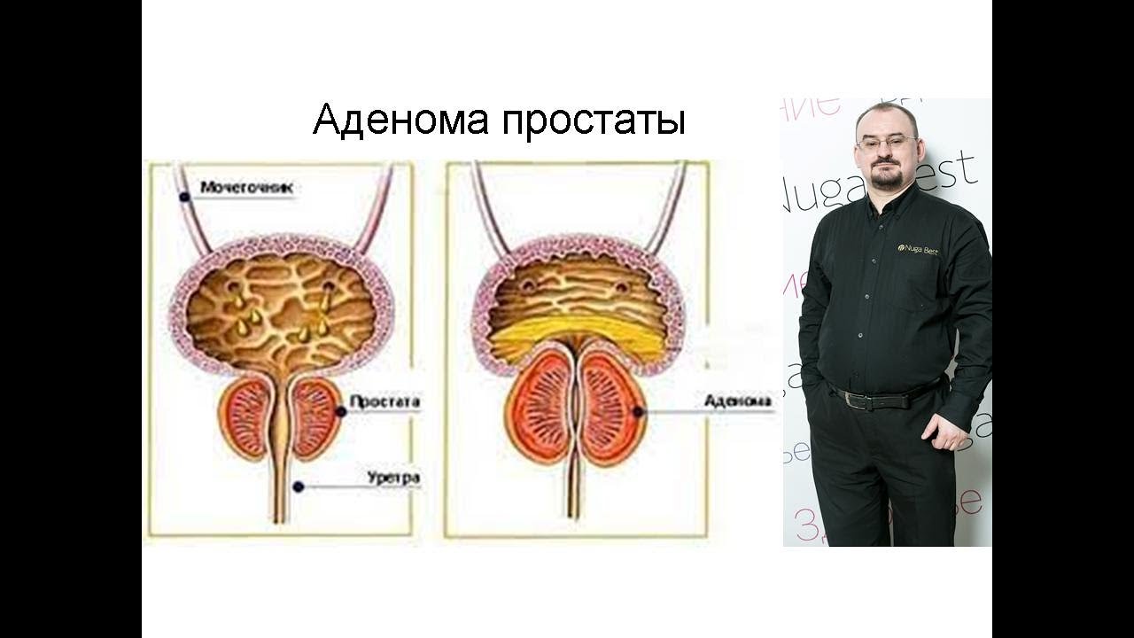 Как лечить аденому простаты?