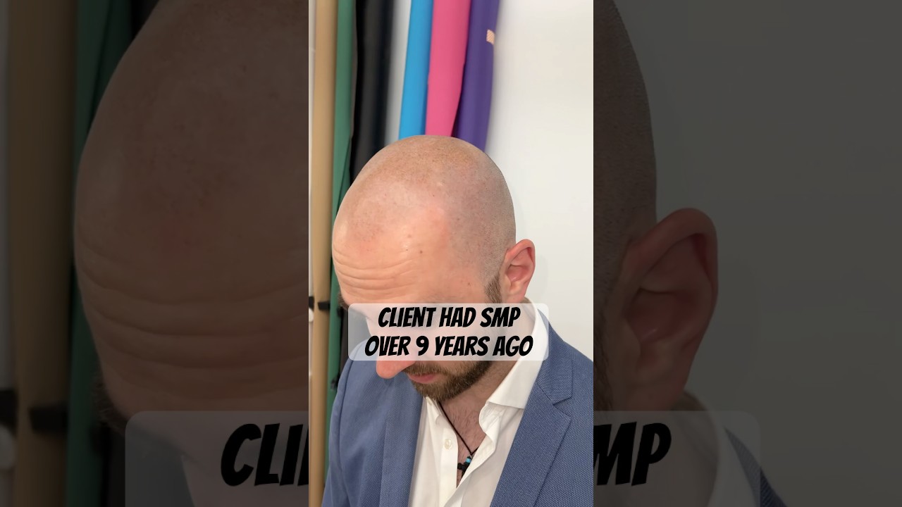 What does Scalp Pigmentation look like after 9 years?