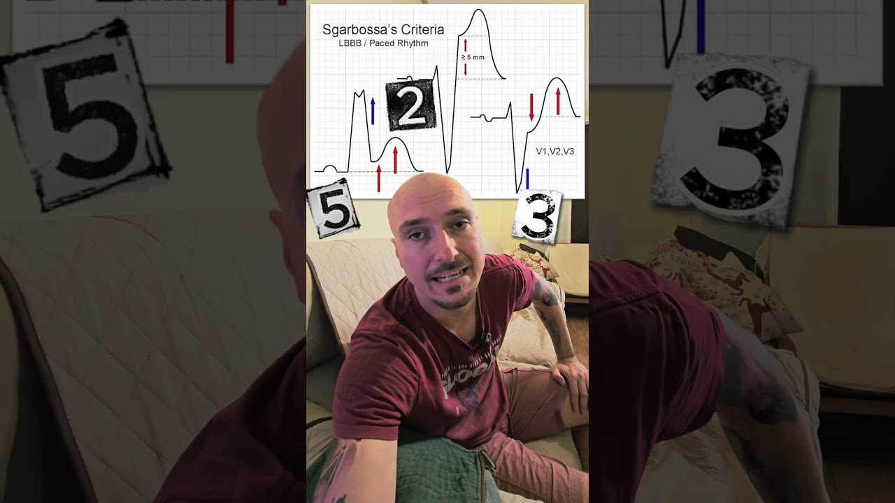 Критерии Сгарбосса-Смита    #ecg #cardiology #stemi
