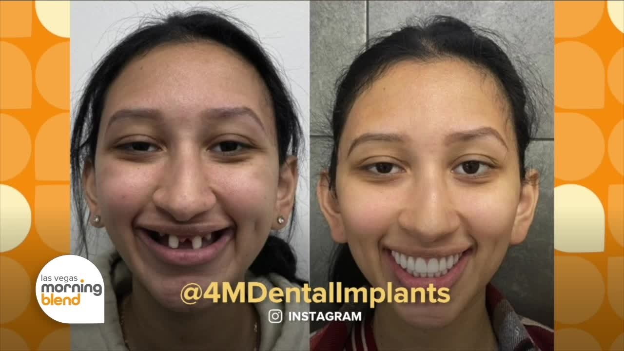 Permanent Teeth in 24 Hours: A New Smile with Dr  Sean