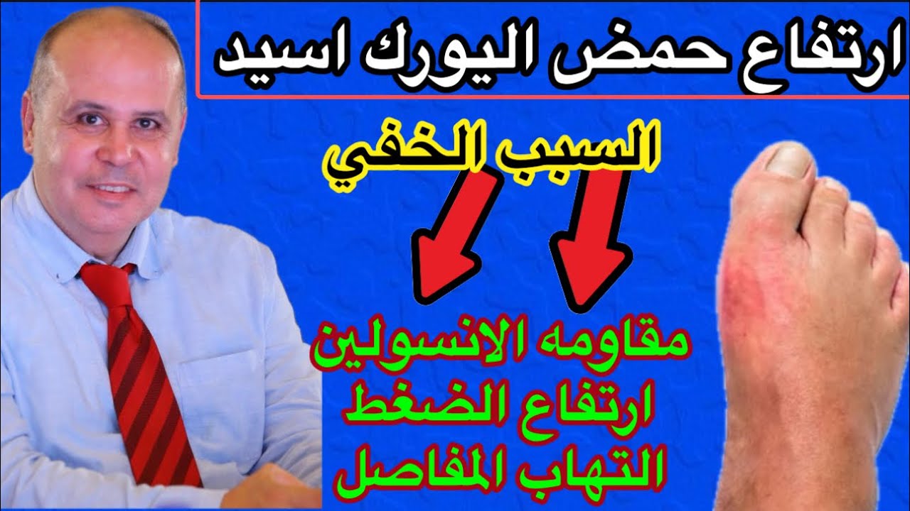 اكتشف الحقيقه ..ارتفاع حمض اليورك اسيد (النقرس) يكشف مقاومه الانسولين  والسكري ..ويسبب ارتفاع الضغط