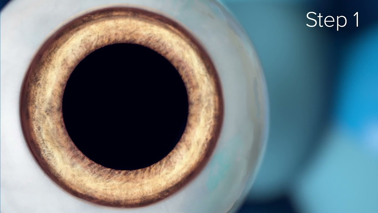 How does the ICL (Implantable contact lens) procedure work?