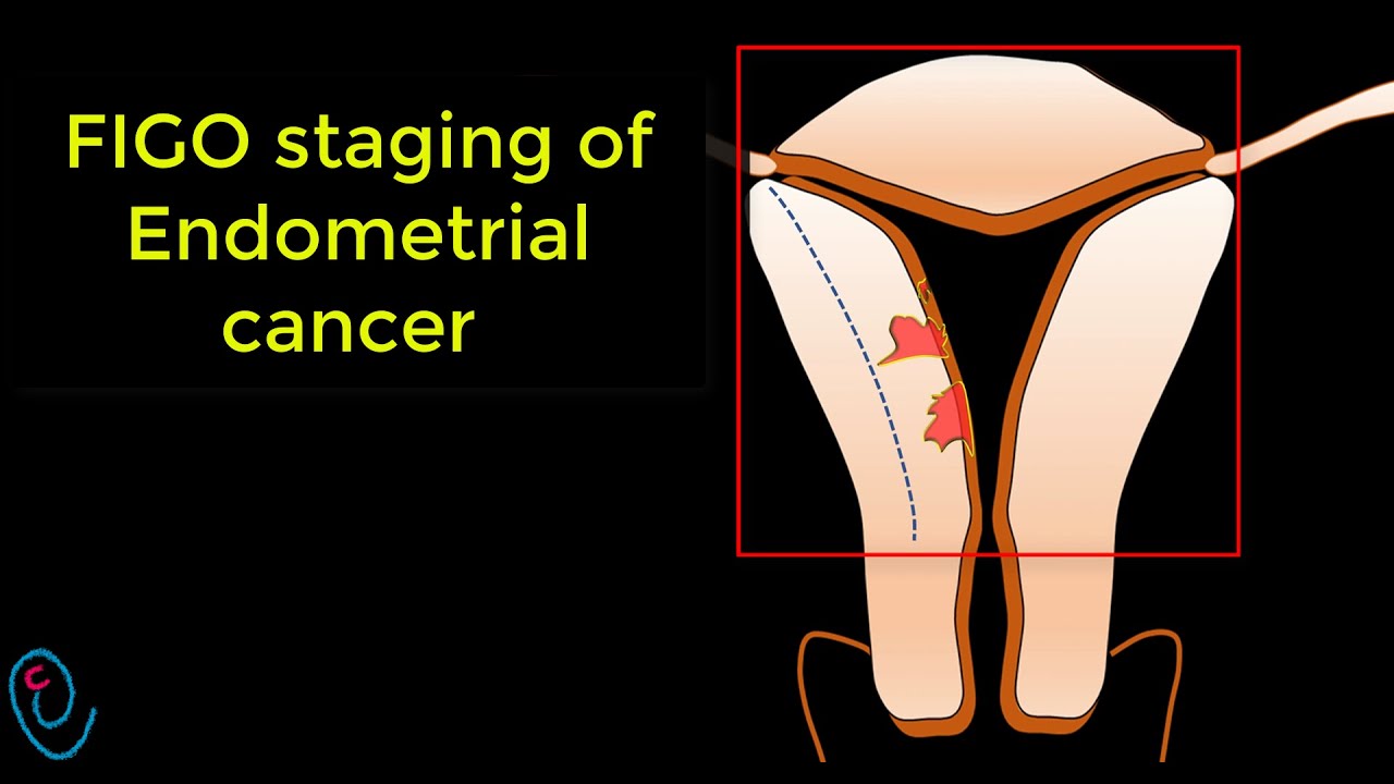 FIGO staging of endometrial cancer