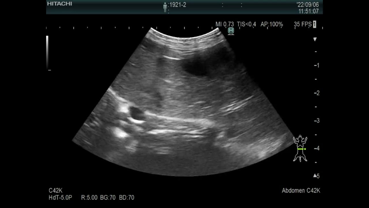Echo image of hepatic stromal tumor in a dog（犬の肝臓間質肉腫のエコー）