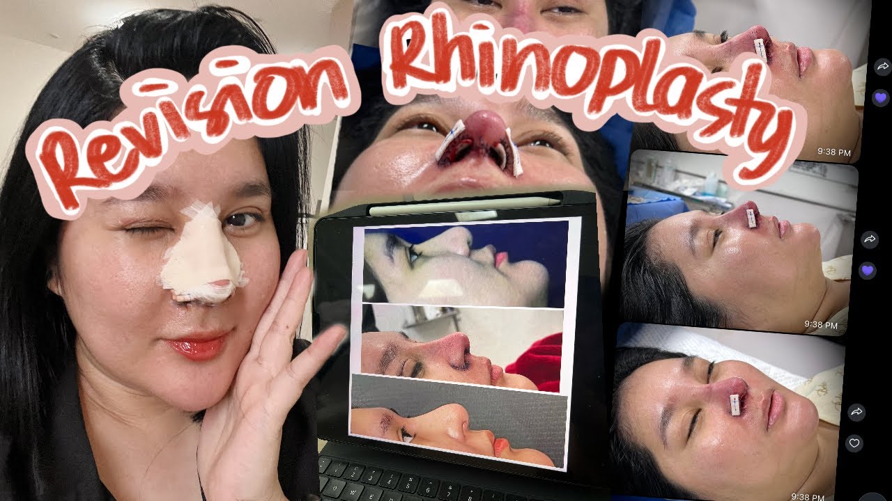 RHINOPLASTY 6 MONTHS LATER... ( MagpapaREVISION ako!) | Kris Lumagui