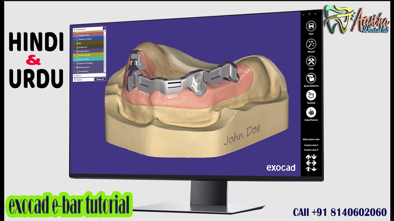 Titanium Bar Designing in Exocad | Complete Step-by-Step Guide