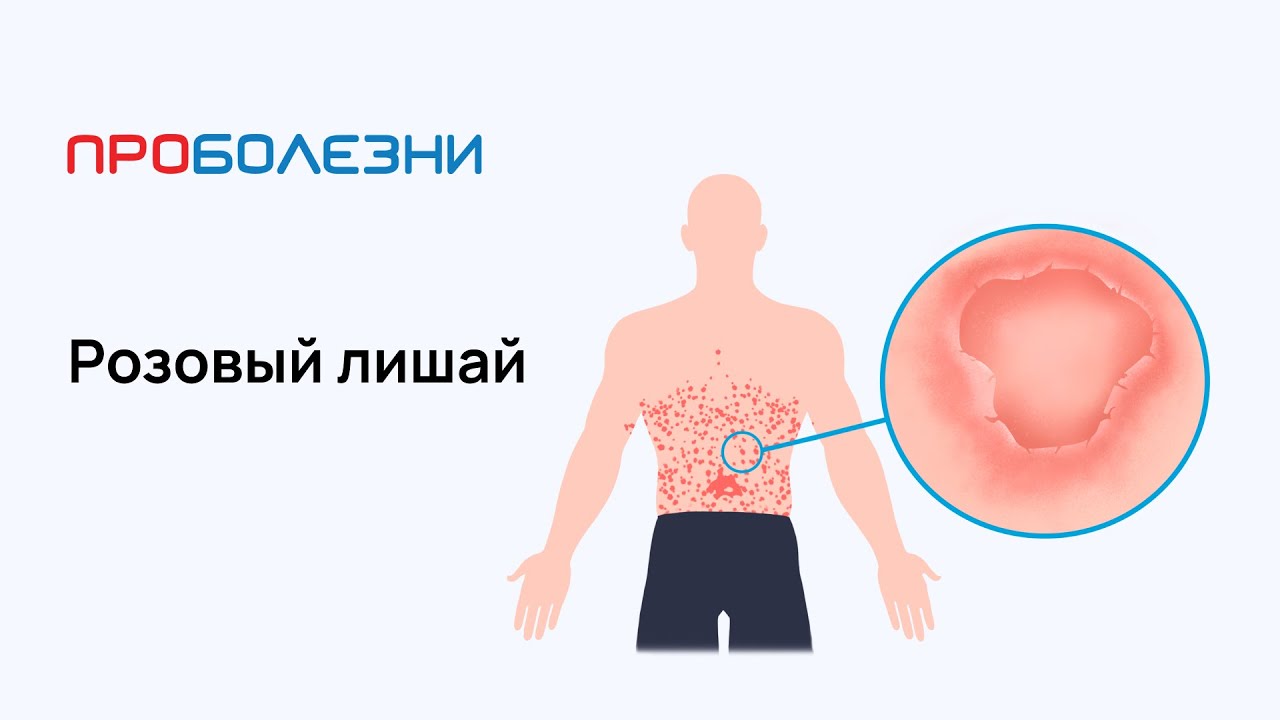 Розовый лишай