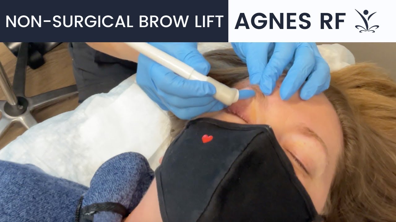 Get a Non-Surgical Eyebrow Lift with Agnes RF!