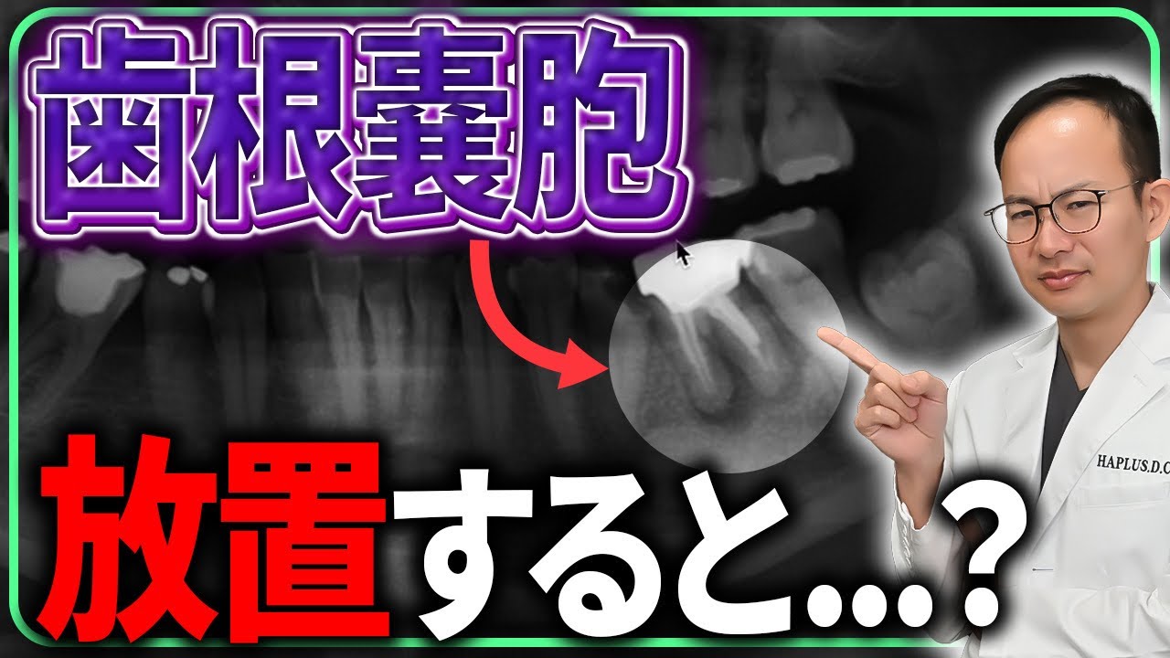 歯根嚢胞を放置すると抜歯になる？！歯根嚢胞を治療しないでいた末路や嚢胞の悪化する経過についてご説明させていただきます