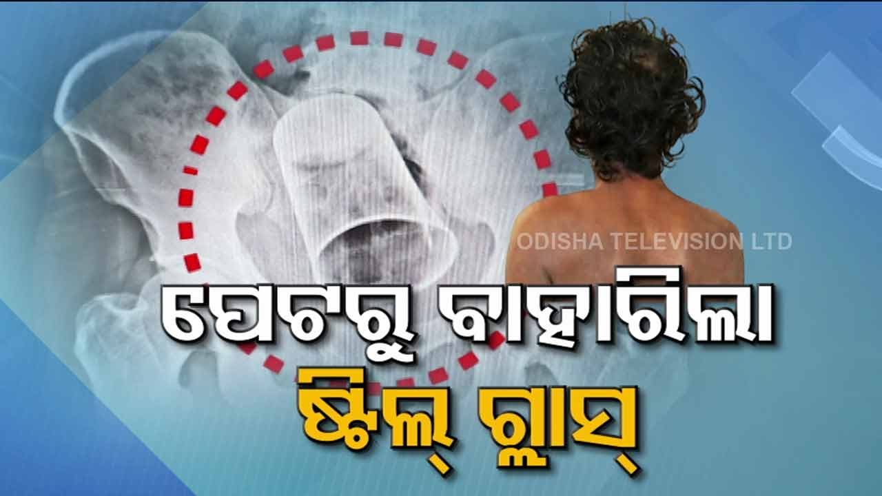 Rare surgery in Berhampur MKCG, surgeons remove steel glass from man's intestine | Special Story