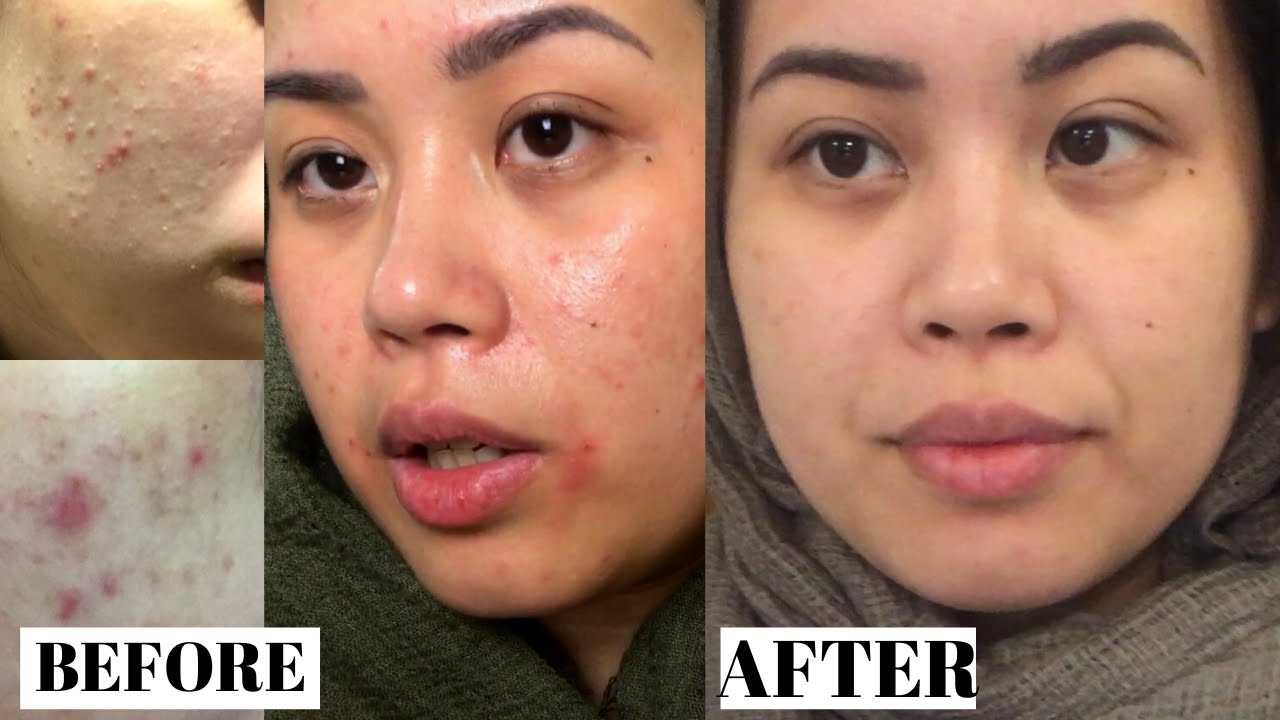 Using Differin for 1 Month | Adult Acne | Sam Vlogs