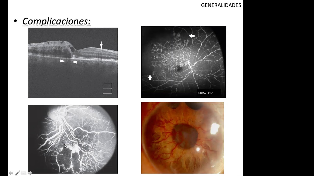 Oclusiones Venosas Retinales