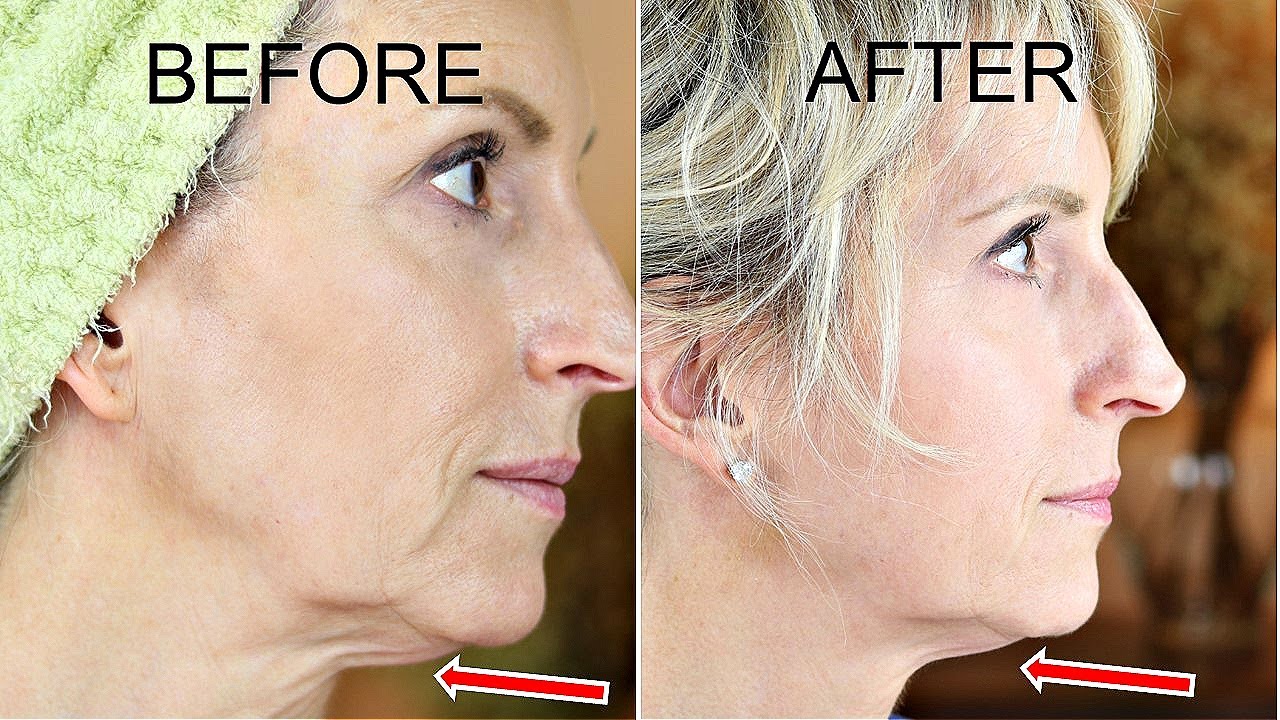 Обзор устройства для подтяжки кожи и борьбы со старением | EvenSkyn LUMO | До и после