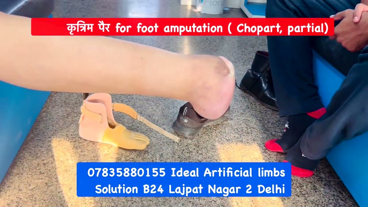 Nakli Tang l Nakli Per l ArtificialLeg l best artificial limb clinic in india l