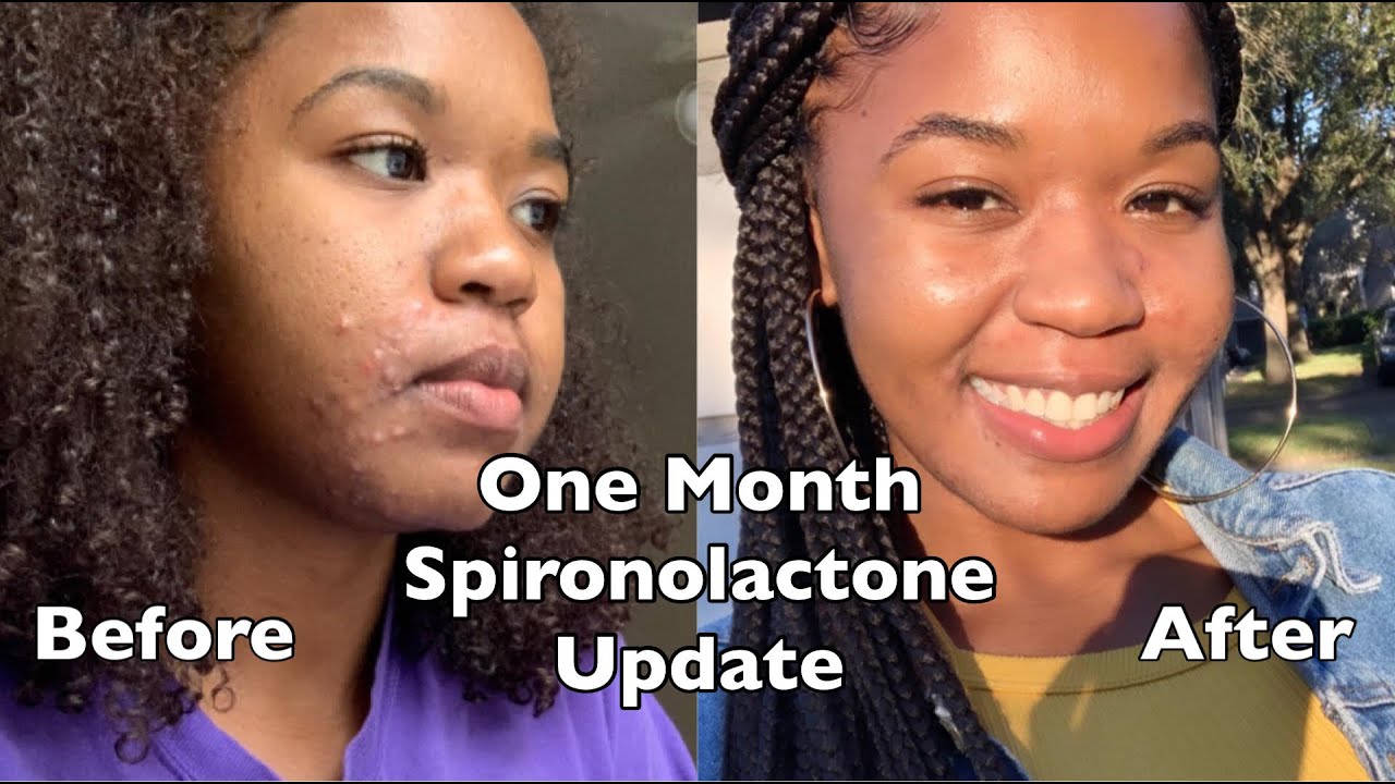My Hormonal Acne Journey | Spironolactone (1 Month Update) | Side Effects & Routine