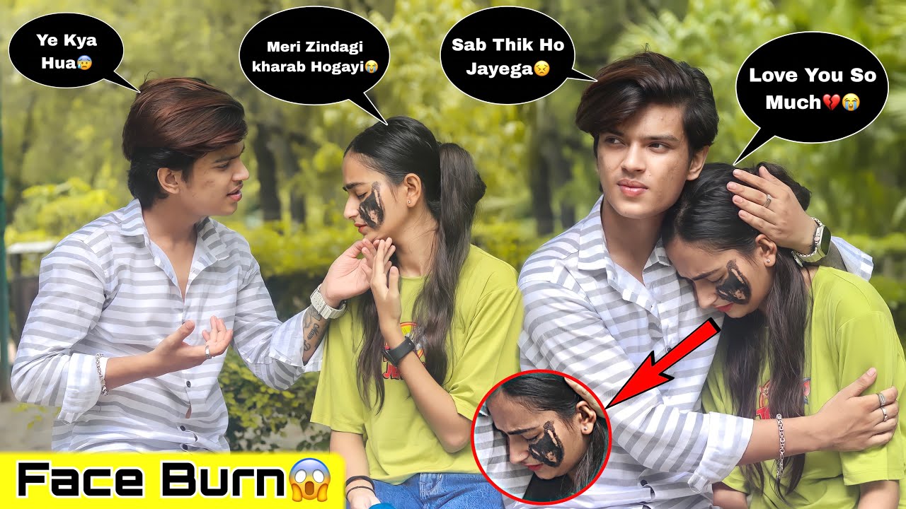 Face Burn Prank || Prank On Boyfriend (Gone Extremely Wrong😱) || Shahfaiz World