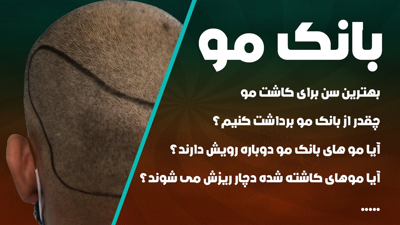 آیا موهای کاشت شده دچار ریزش می شوند؟ 0 تا 100 کاشت مو
