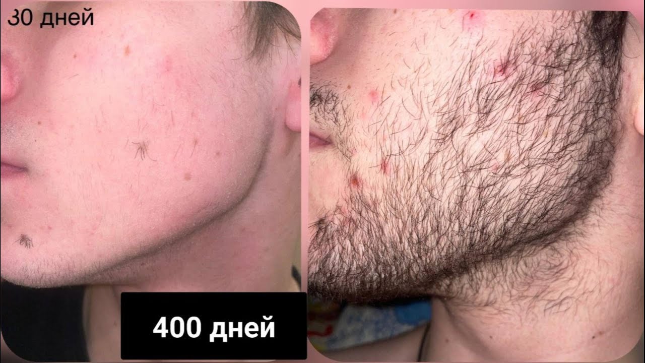 400 дней мажу Минокс на бороду. Средство для роста бороды.  Андрей Борода выпуск 94