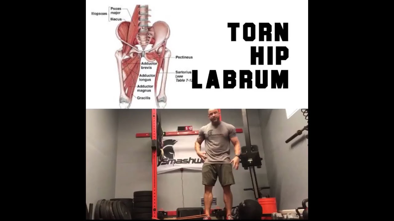 Torn Hip Labrum? DO THIS NOW! | SmashweRx | Trevor Bachmeyer