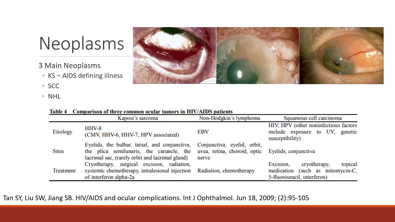 The Effects of HIV in the Eye