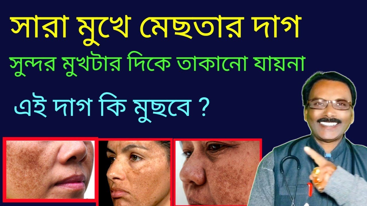 এবার মুছে যাবে মেচেতার দাগ || melasma medicine in homeopathy || Dr SP Goswami