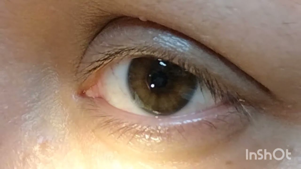 Reflejo Fotomotor/Motilidad ocular Intrínseca.                 (III,IV,VI PAR CRANEAL)