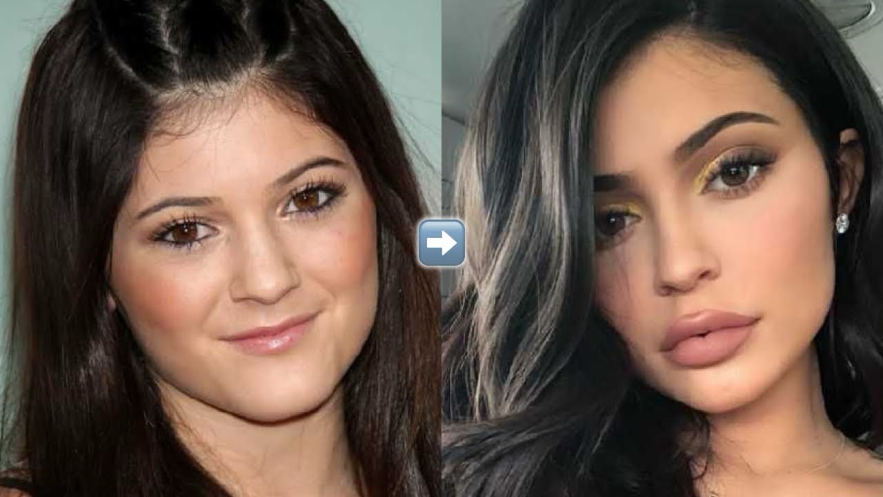 ˚. ྀིྀི୧❤︎୨ ྀིྀི.˚ give me KYLIE’s full face 💉🪽 every procedure she’s ever had - ᨳ꒰ ୨୧ ꒱ഒ -