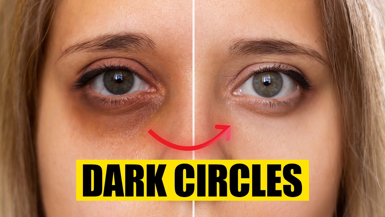 Get Rid of Dark Circles For Good