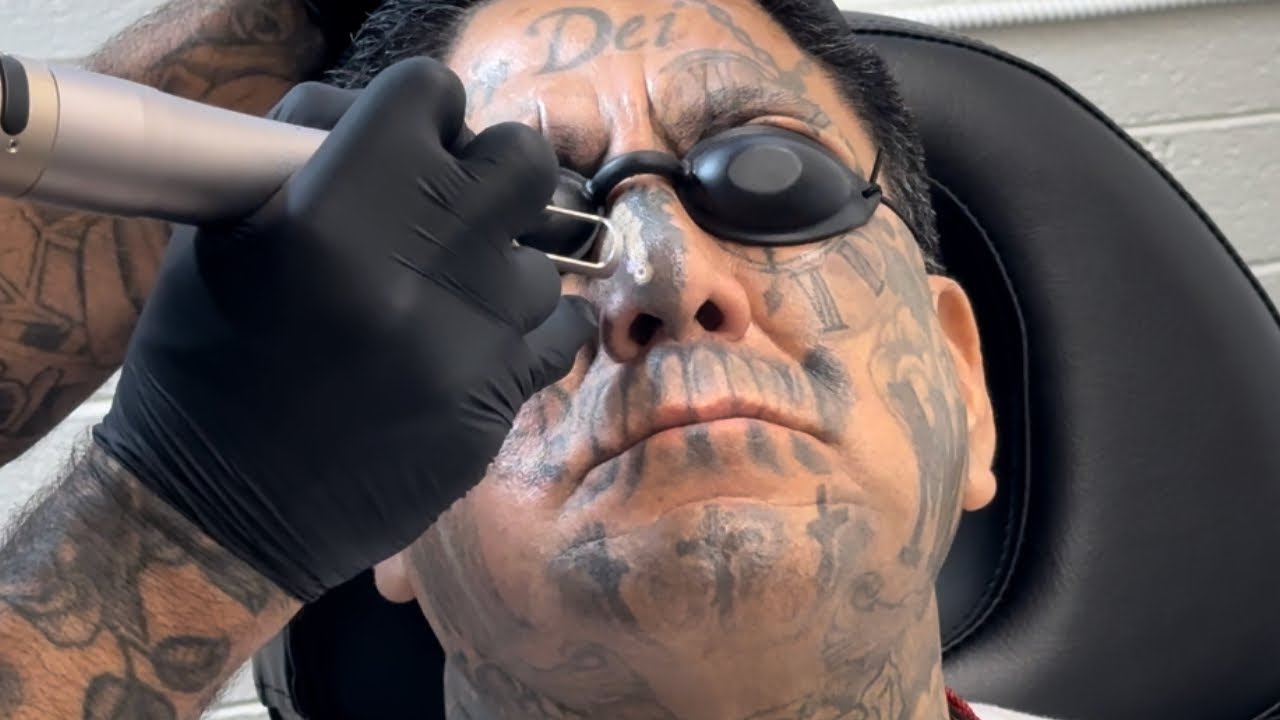 Удаление татуировок на лице в The Ink Eraser Session 2