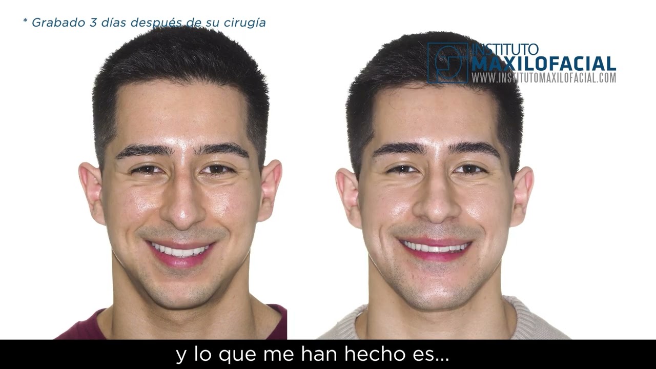 Cirugía ortofacial. Caso # 92: Rodrigo - Clase II, biretrusión maxilomandibular
