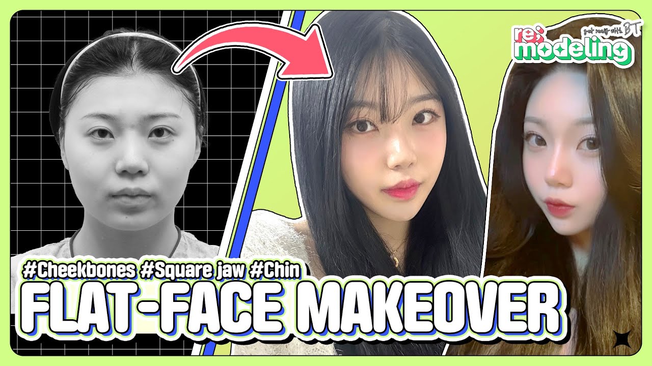 Best Facial Contouring Korea Before and After | V Line Cheekbone Surgery #koreaplasticsurgery