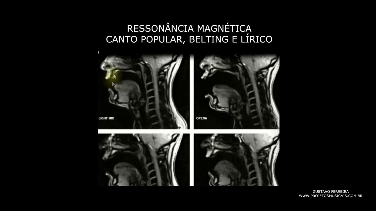 RESSONÂNCIA DA VOZ NO CANTO POPULAR, BELTING E LÍRICO (c/ ressonância magnética)