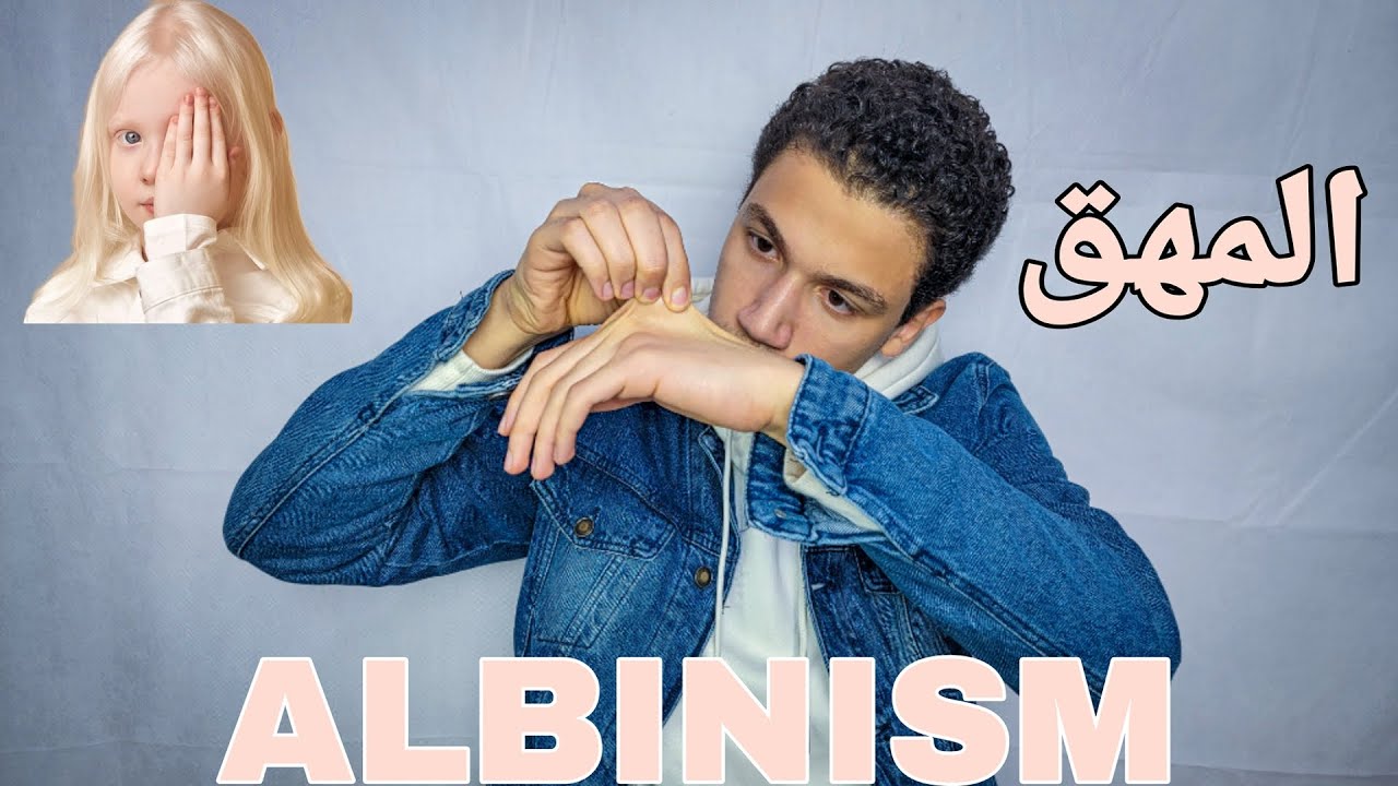 ALBINO|الاشخاص الي لونهم ابيض بزيادة