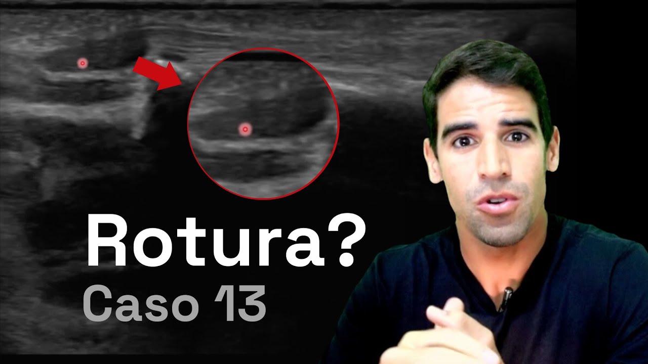 Punho: Rotura dos tendões? Atrofia? Como avaliar no ULTRASSOM? | Caso 013 - MSKD