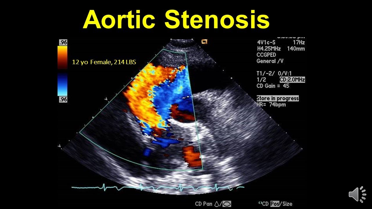 Turbulent Blood Flow in Aortic Stenosis