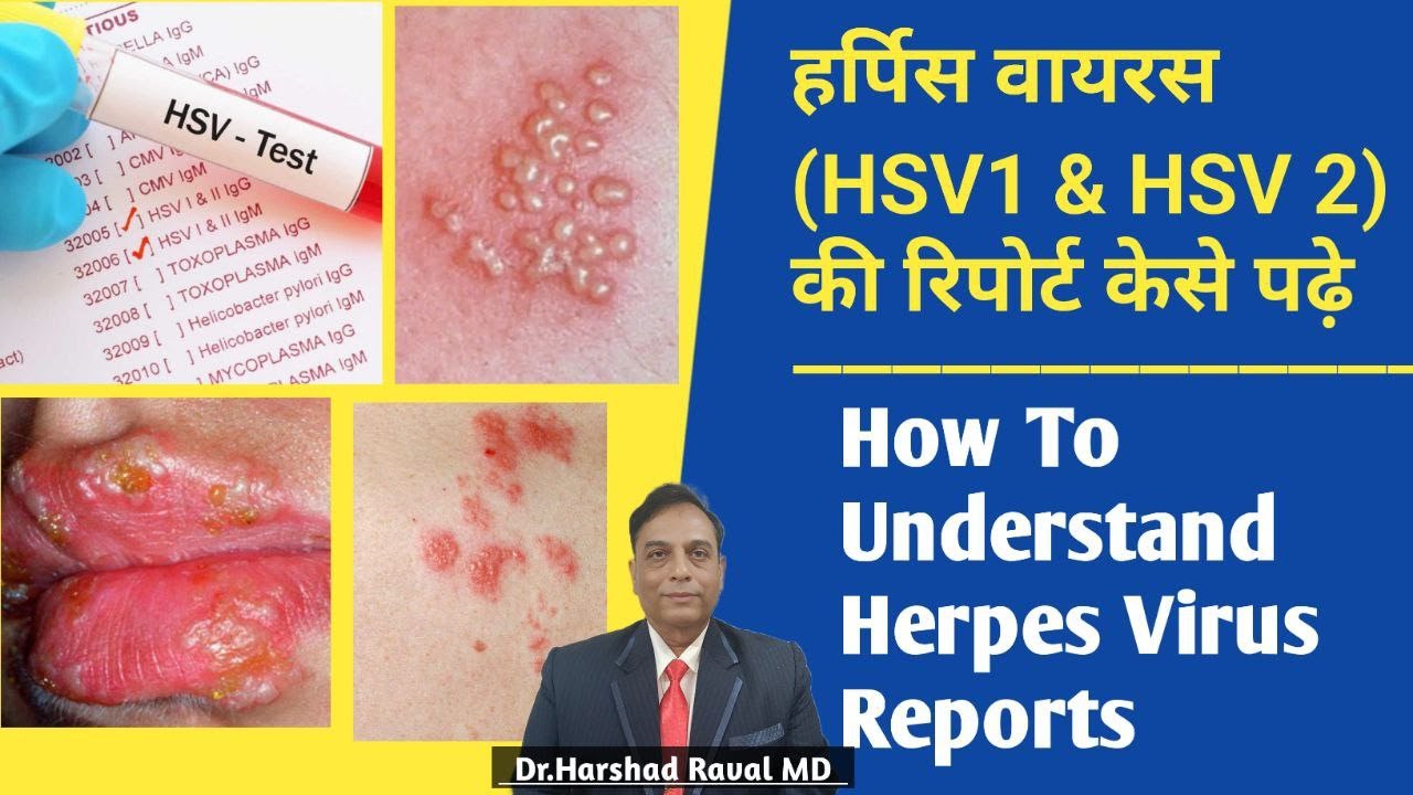 हर्पिस वायरस (HSV1 & HSV 2) की रिपोर्ट केसे पढ़े l How To Understand Herpes Virus Reports
