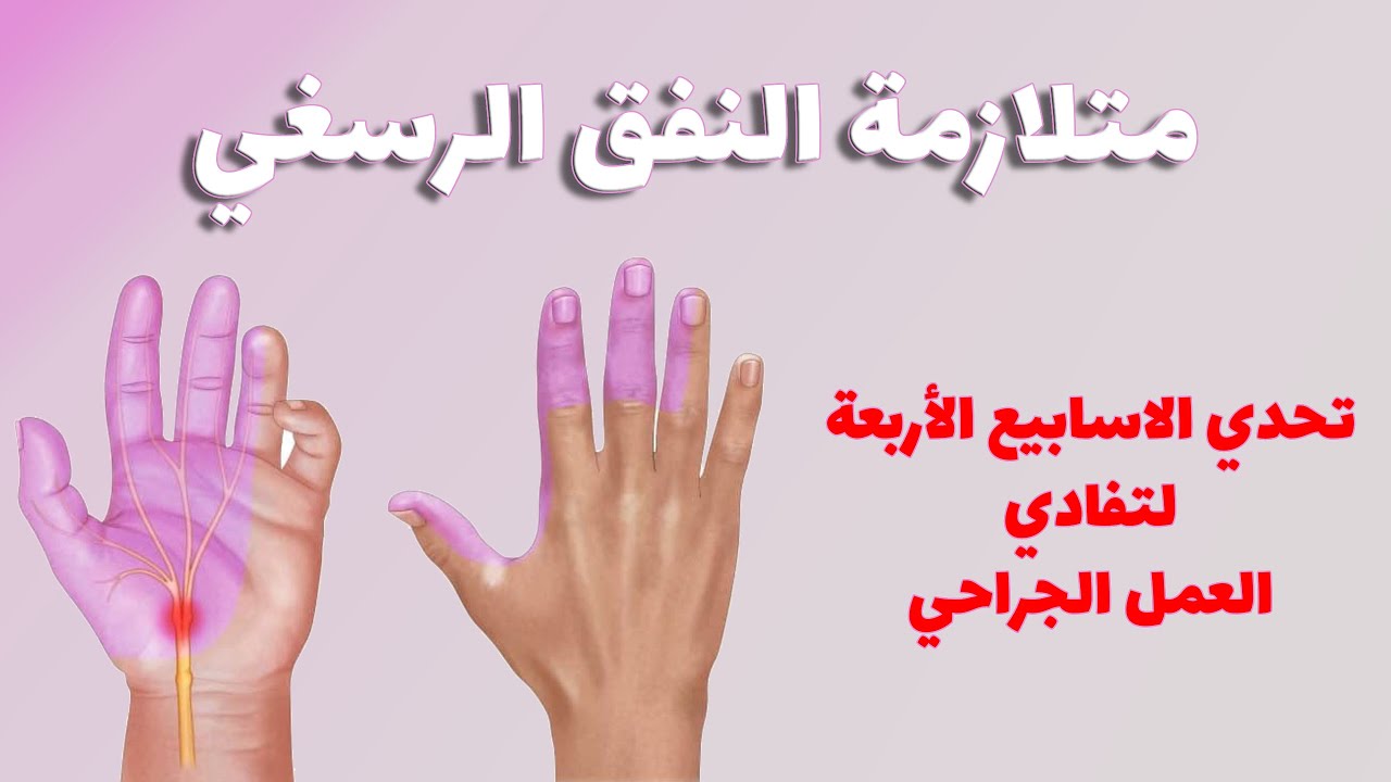متلازمة النفق الرسغي - تفادي حقن الإبر و العمليات الجراحية. تحدي الأربعة اسابيع و نتائج مبهرة