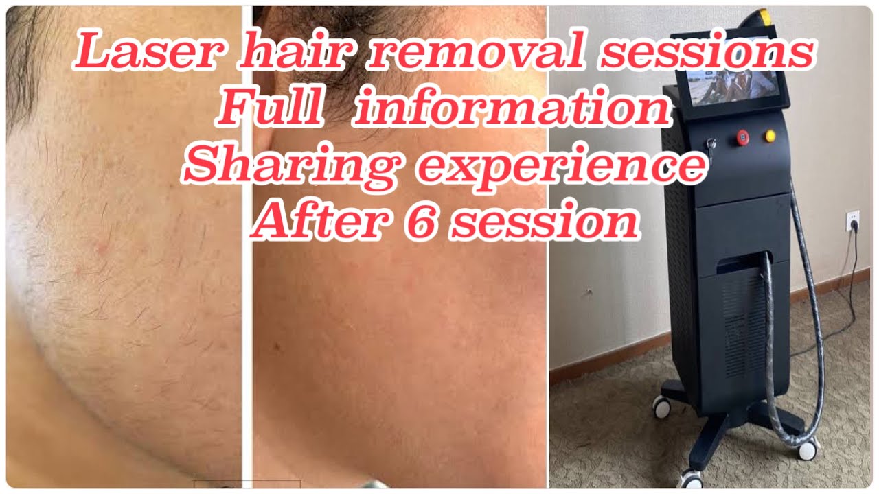 Laser Hair Removal Session Full Information in 2025|Sharing Experience After 6session😍