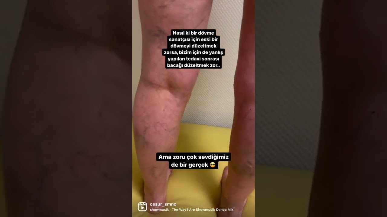 Ameliyatsız varis tedavisi
