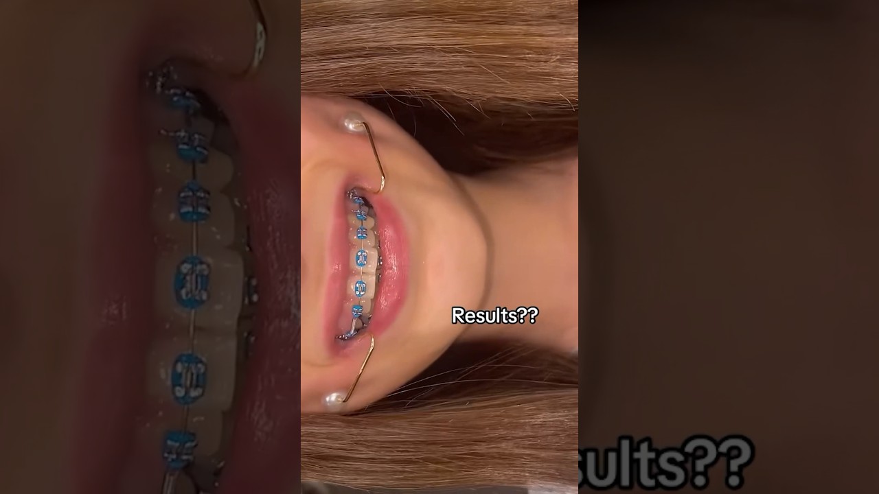 Can you Really Get Dimples Using THIS Device?! 🦷😬