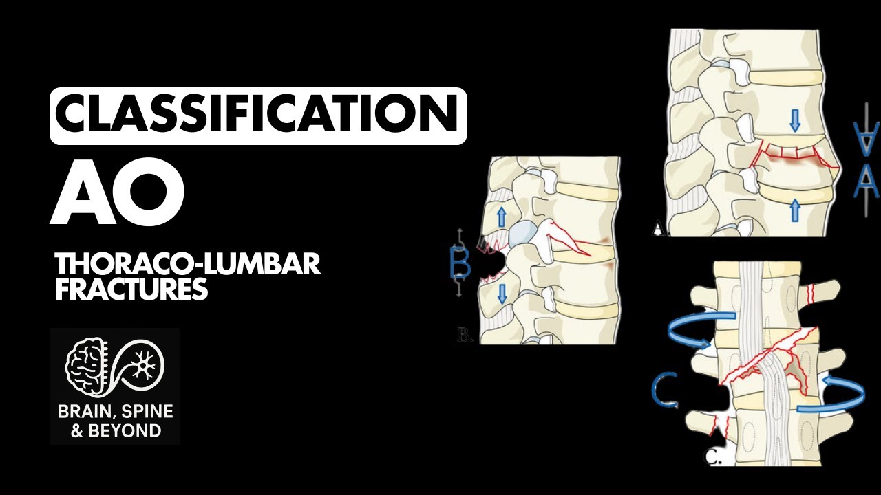 AO Classification Thoracolumbar Fractures