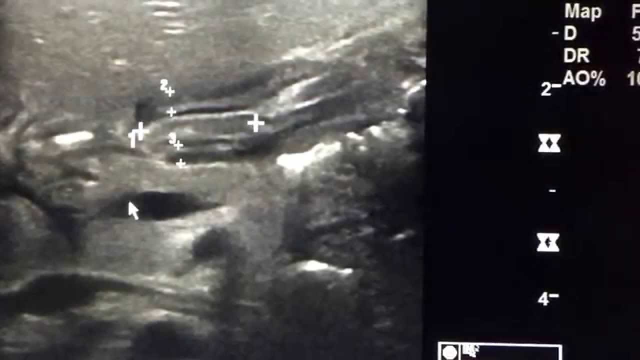 Pyloric Stenosis