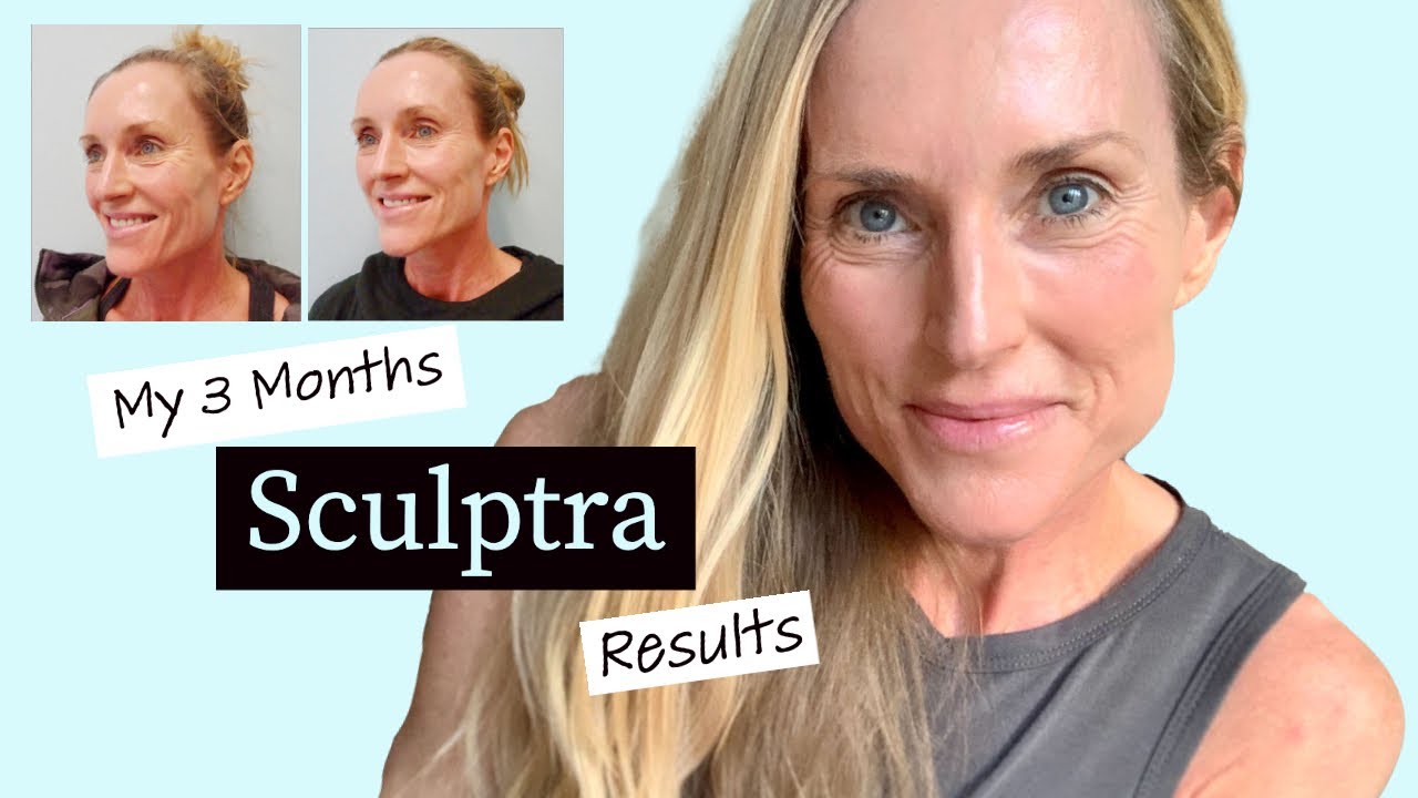 My 3 months SCULPTRA update with BEFORE & AFTER Pictures