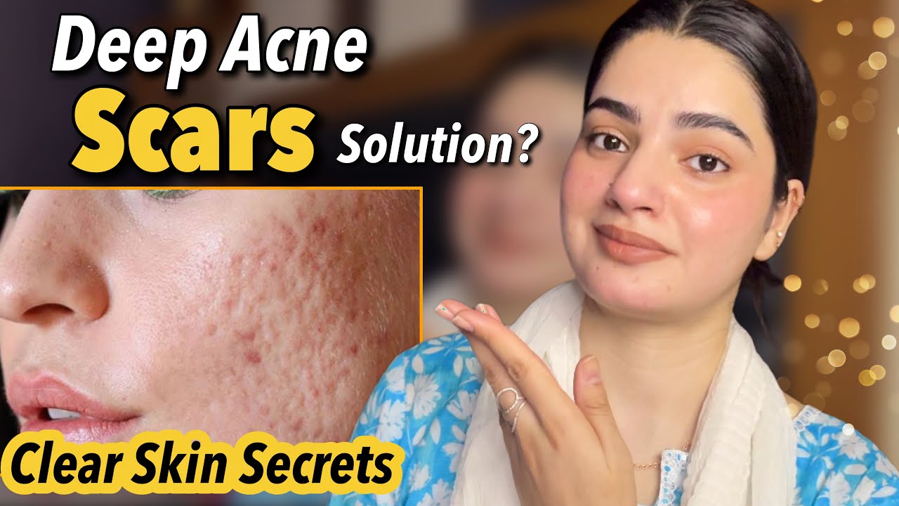 Deep Acne Scars? Try This Powerful Home Treatment (FAST Results) 