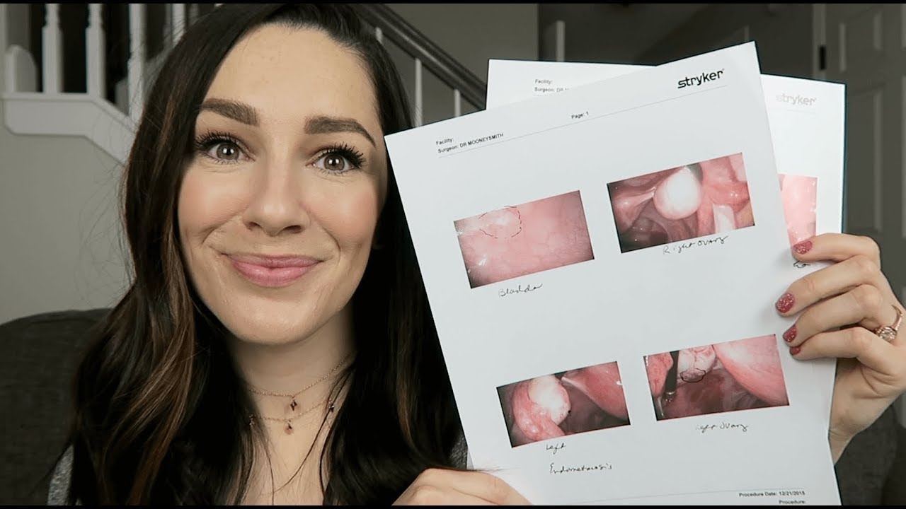 My Endometriosis Story
