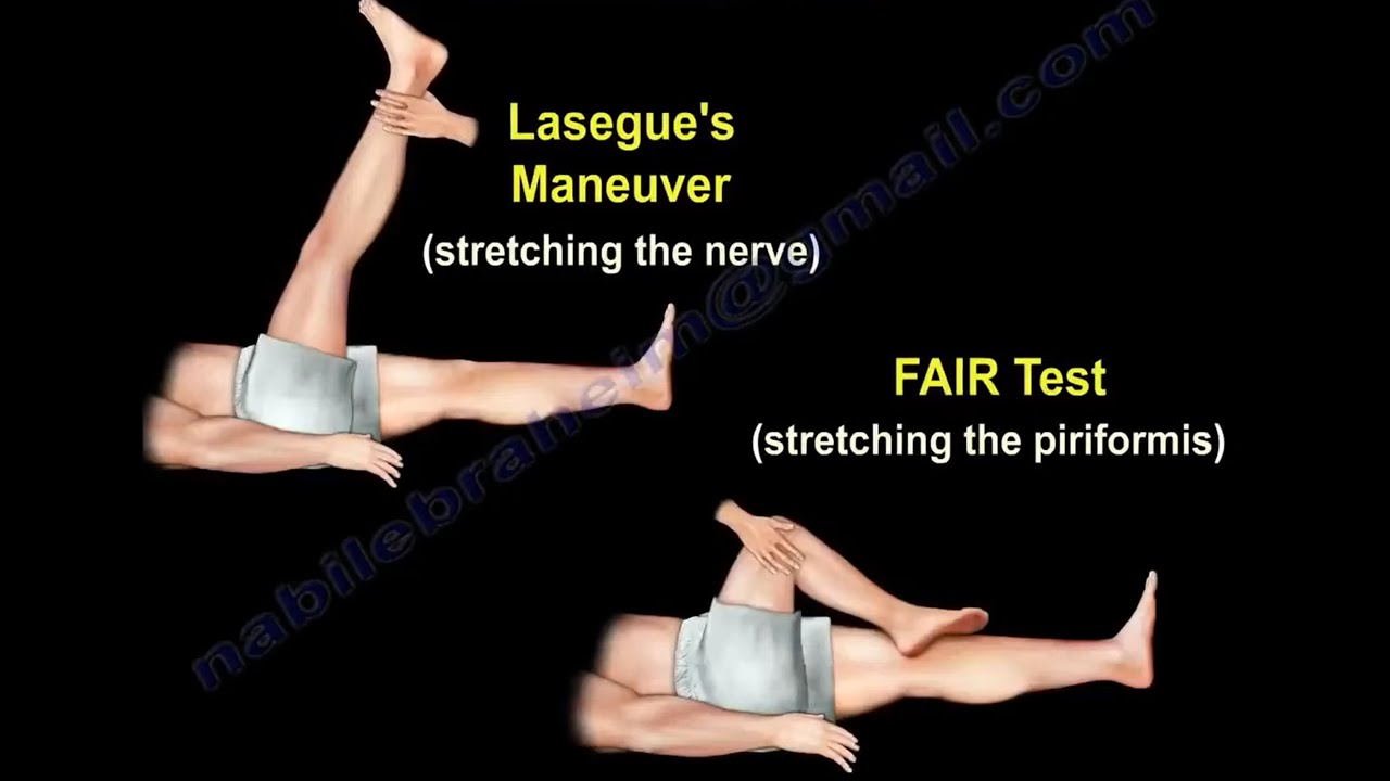 Test du piriforme, syndrome du piriforme