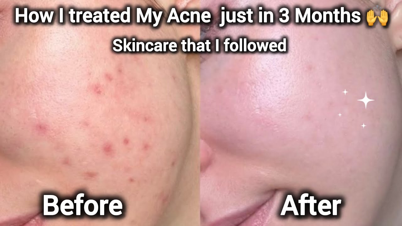 How to Treat Acne | Treat all Your  Skin Problems | Harmonal Acne and Closed Comedones ✨️
