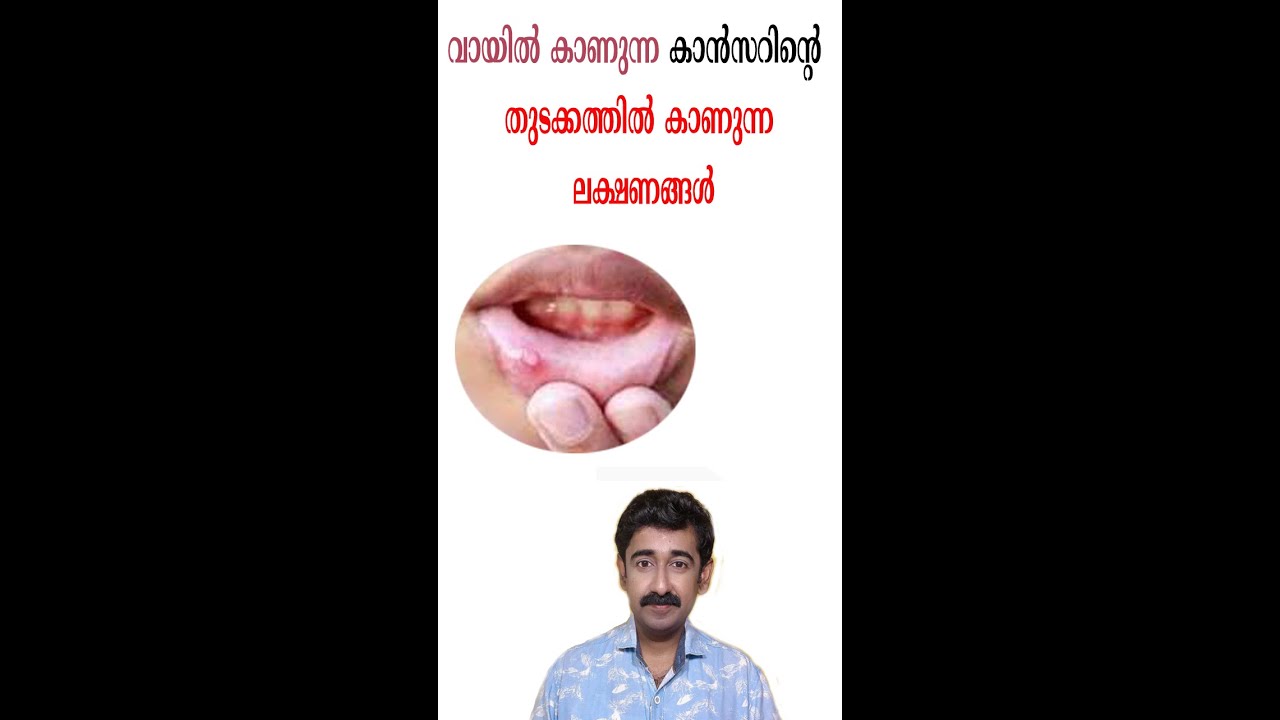 വായിൽ കാണുന്ന കാൻസറിന്റെ തുടക്കത്തിൽ കാണുന്ന ലക്ഷണങ്ങൾ#short #healthtips #drrajeshkumar