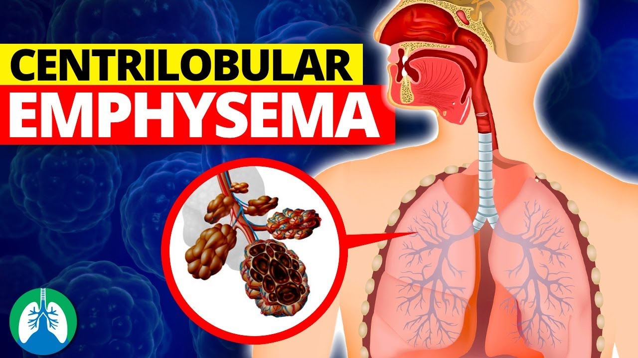 Centrilobular Emphysema (Medical Definition) | Quick Explainer Video