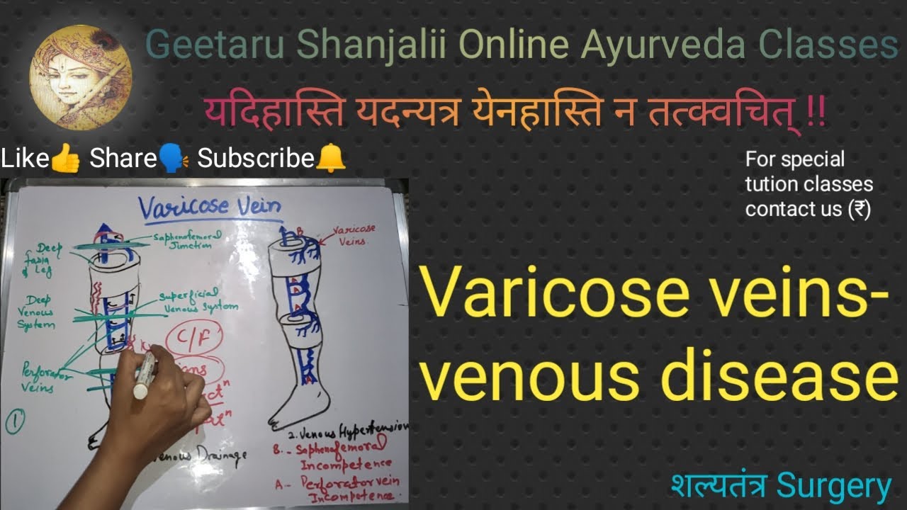 #Varicose vein #venousDisease #geetaru #gitaru #shalytantra #surgery #BAMS #AIAPGET #Ayureveda